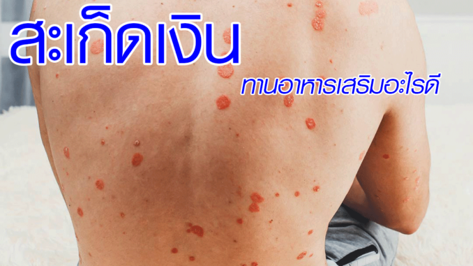 Psoriasis